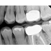 Kodak RVG 6200 - радиовизиограф, 24 пар линий/мм | Carestream Dental (США)