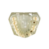 CRYSTAL IMPLANT MODEL - модель для демонстрации установки имплантатов | Hanil (Ю. Корея)