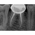 Kodak RVG 5200 - радиовизиограф, 16 пар линий/мм | Carestream Dental (США)