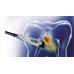 DIAGNOdent pen 2190 - прибор для диагностики раннего и скрытого кариеса | KaVo (Германия)
