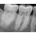 Kodak RVG 6200 - радиовизиограф, 24 пар линий/мм | Carestream Dental (США)