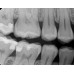 Kodak RVG 6200 - радиовизиограф, 24 пар линий/мм | Carestream Dental (США)
