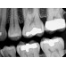 Kodak RVG 6200 - радиовизиограф, 24 пар линий/мм | Carestream Dental (США)