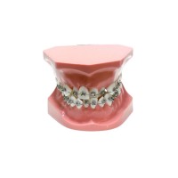 ORB02 – ортодонтическая модель с брекетами и твердой десной, 1 класс | GF Dental (Италия) 