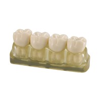 TOOTH MODEL W-TYPE - модель из 4-х зубов, демонстрирующая стадии кариеса | Hanil (Ю. Корея)