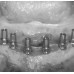 LM Implant Misura MR 3.3-5.6 - инструмент для позиционирования имплантатов | LM-Instruments Oy (Финляндия)