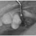 LM Implant Misura MR 3.3-5.6 - инструмент для позиционирования имплантатов | LM-Instruments Oy (Финляндия)