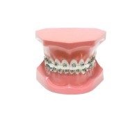 ORB01 – ортодонтическая модель с брекетами и твердой десной, 1 класс | GF Dental (Италия) 